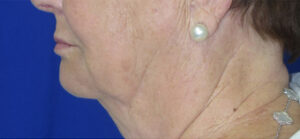 CO2 Laser Case 6633 Before Photo CO2 Laser