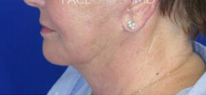 CO2 Laser Case 6633 After Photo CO2 Laser
