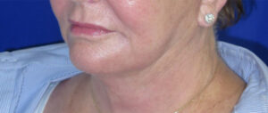 CO2 Laser Case 6633 After Photo CO2 Laser