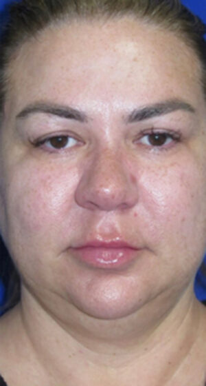 FACEology Lift / Neck Lift Case 6635 Before Photo FACEology Lift / Neck Lift