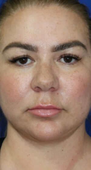 FACEology Lift / Neck Lift Case 6635 After Photo FACEology Lift / Neck Lift