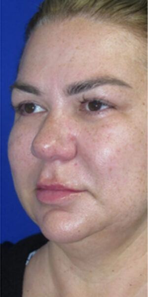 FACEology Lift / Neck Lift Case 6635 Before Photo FACEology Lift / Neck Lift