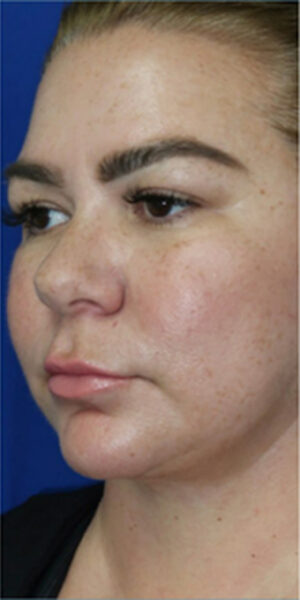 FACEology Lift / Neck Lift Case 6635 After Photo FACEology Lift / Neck Lift
