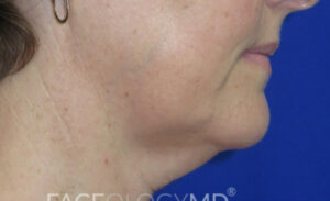 FACEology Lift / Neck Lift Case 6636 Before Photo FACEology Lift / Neck Lift