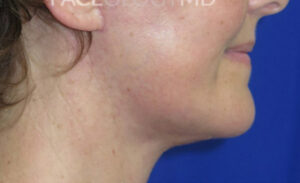 FACEology Lift / Neck Lift Case 6636 After Photo FACEology Lift / Neck Lift