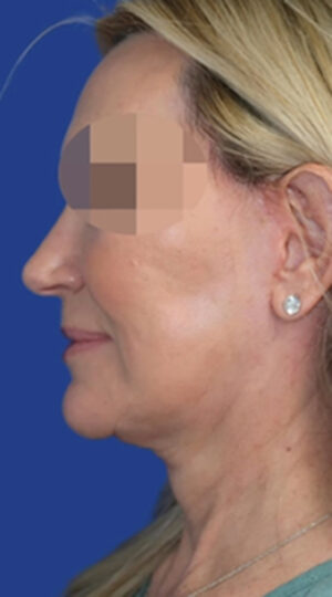 CO2 Laser Case 6639 After Photo CO2 Laser