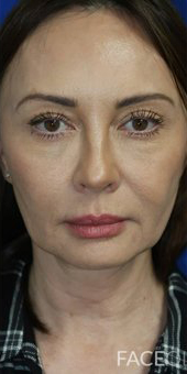 FACEology Lift / Neck Lift Case 6696 Before Photo FACEology Lift / Neck Lift