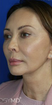 FACEology Lift / Neck Lift Case 6696 After Photo FACEology Lift / Neck Lift