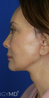 FACEology Lift / Neck Lift Case 6696 After Photo FACEology Lift / Neck Lift