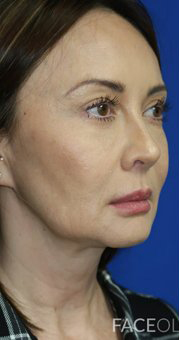 FACEology Lift / Neck Lift Case 6696 Before Photo FACEology Lift / Neck Lift