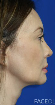 FACEology Lift / Neck Lift Case 6696 Before Photo FACEology Lift / Neck Lift