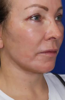 CO2 Laser Case 6760 After Photo CO2 Laser