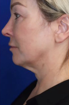 CO2 Laser Case 6760 Before Photo CO2 Laser