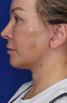 CO2 Laser Case 6760 After Photo CO2 Laser