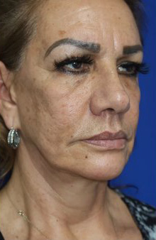 FACEology Lift / Neck Lift Case 6762 Before Photo FACEology Lift / Neck Lift