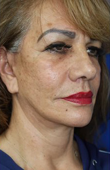 FACEology Lift / Neck Lift Case 6762 After Photo FACEology Lift / Neck Lift