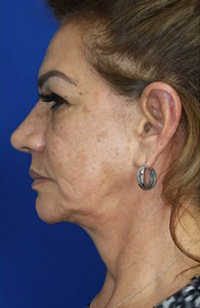 FACEology Lift / Neck Lift Case 6762 Before Photo FACEology Lift / Neck Lift