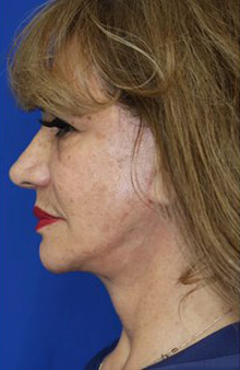 FACEology Lift / Neck Lift Case 6762 After Photo FACEology Lift / Neck Lift