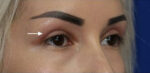 Eyelid Lift