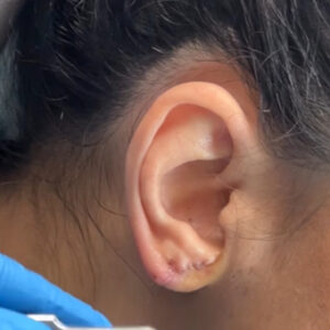 Ear Surgery Case 6724 After Photo Ear Surgery