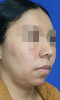 Chin Liposuction Case 6727 Before Photo Chin Liposuction
