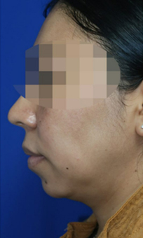 Chin Liposuction Case 6727 Before Photo Chin Liposuction