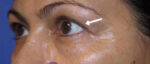 Eyelid Lift