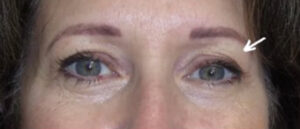 Eyelid Lift Case 6742 Before Photo Eyelid Lift