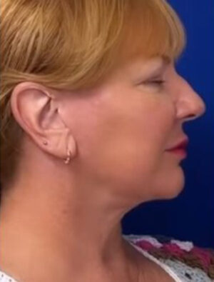 FACEology Lift / Neck Lift Case 6812 After Photo FACEology Lift / Neck Lift