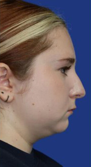 Chin Liposuction