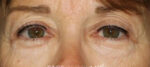 Eyelid Lift