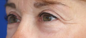 Eyelid Lift Case 6845 After Photo Eyelid Lift