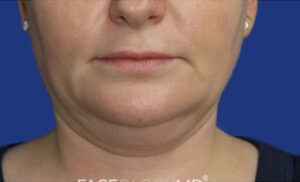 FACEology Lift / Neck Lift Case 6843 Before Photo FACEology Lift / Neck Lift