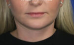 FACEology Lift / Neck Lift