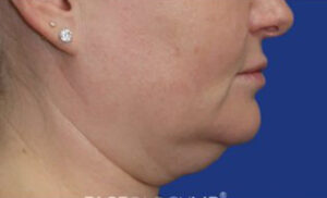 FACEology Lift / Neck Lift Case 6843 Before Photo FACEology Lift / Neck Lift