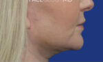 FACEology Lift / Neck Lift