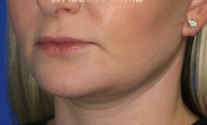 FACEology Lift / Neck Lift Case 6843 After Photo FACEology Lift / Neck Lift