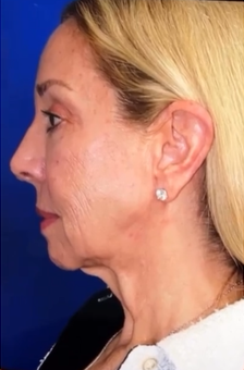 FACEology Lift / Neck Lift Case 9762 Before Photo FACEology Lift / Neck Lift