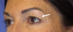Eyelid Lift Case 9765 Before Photo Eyelid Lift
