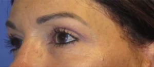 Eyelid Lift Case 9765 After Photo Eyelid Lift