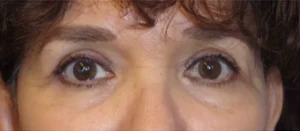 Eyelid Lift