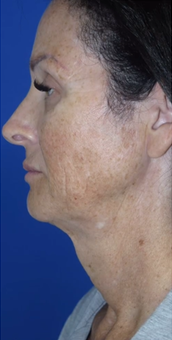 FACEology Lift / Neck Lift Case 9775 Before Photo FACEology Lift / Neck Lift