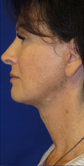 FACEology Lift / Neck Lift Case 9775 After Photo FACEology Lift / Neck Lift