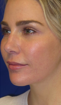 FACEology Lift / Neck Lift