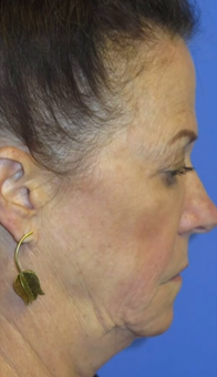 FACEology Lift / Neck Lift Case 9790 Before Photo FACEology Lift / Neck Lift