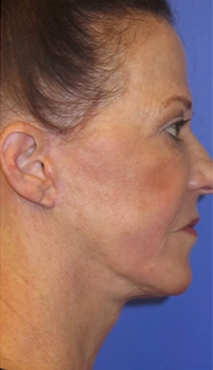 FACEology Lift / Neck Lift Case 9790 After Photo FACEology Lift / Neck Lift