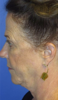 FACEology Lift / Neck Lift