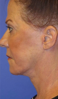 FACEology Lift / Neck Lift Case 9790 After Photo FACEology Lift / Neck Lift