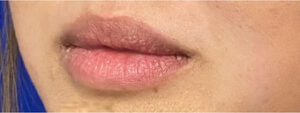 Lip Augmentation Case 10345 Before Photo Lip Augmentation