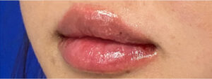 Lip Augmentation Case 10345 After Photo Lip Augmentation